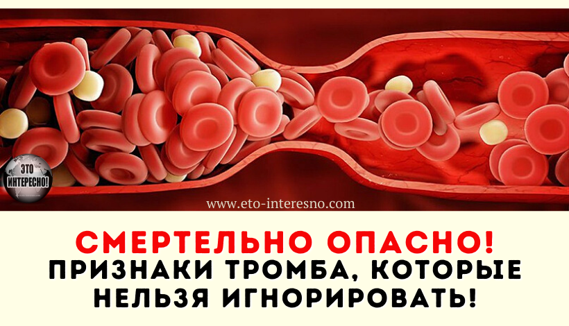 Лекарства растворяющие тромбы в сосудах. Застоявшаяся кровь в организме. Признаки тромба в организме. Как выглядит образование тромба. Размеры тромбов